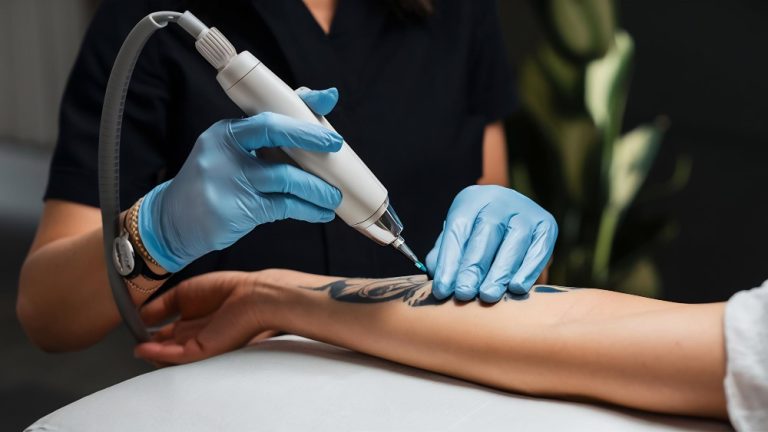 How Do I Start a Tattoo Removal Business